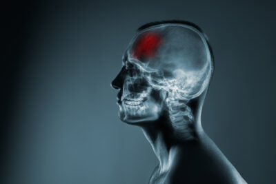 toxic brain injury